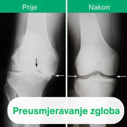OrthoKnee™ – Dugotrajno olakšanje od artritisa i bolova u zglobovima